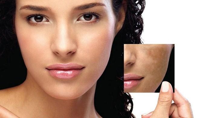 Melasma
