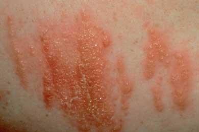 Poison Ivy, Oak and Sumac