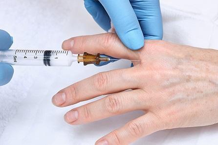 FDA Approves First Hyaluronic Acid Filler for Hands