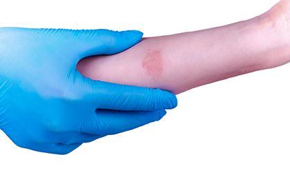 Signs of Lyme disease that appear on your skin